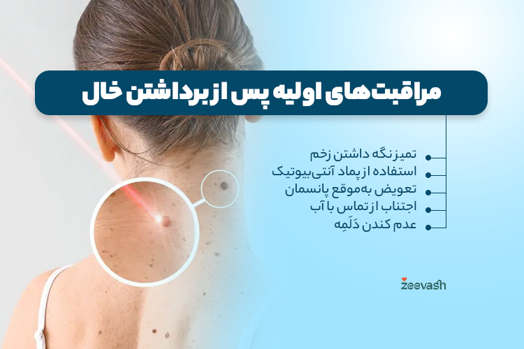 مراقبت های اولیه بعد از برداشتن خال